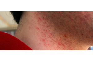 Как предотвратить бритвенный ожог - BritvaMag