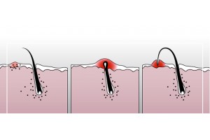 Как избавиться от вросших волос? - BritvaMag